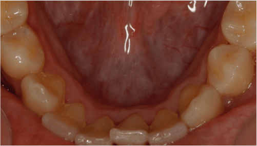 ortodoncia-alineadent-madrid-antes1