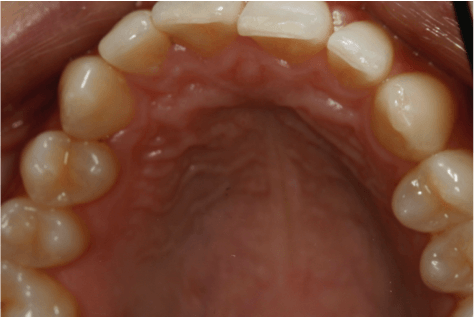 ortodoncia-alineadent-madrid-antes2