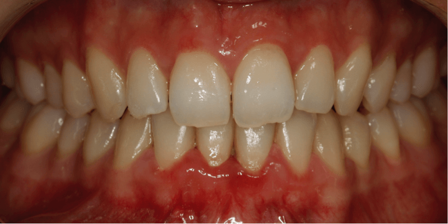 ortodoncia-alineadent-madrid-antes3