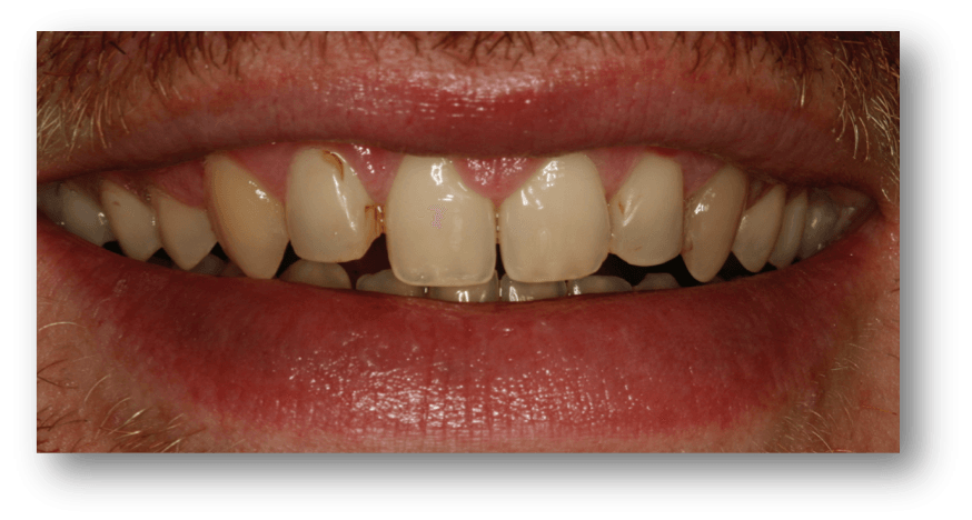 caso carillas dentales madrid1