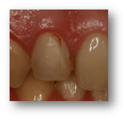caso carillas dentales madrid capital3