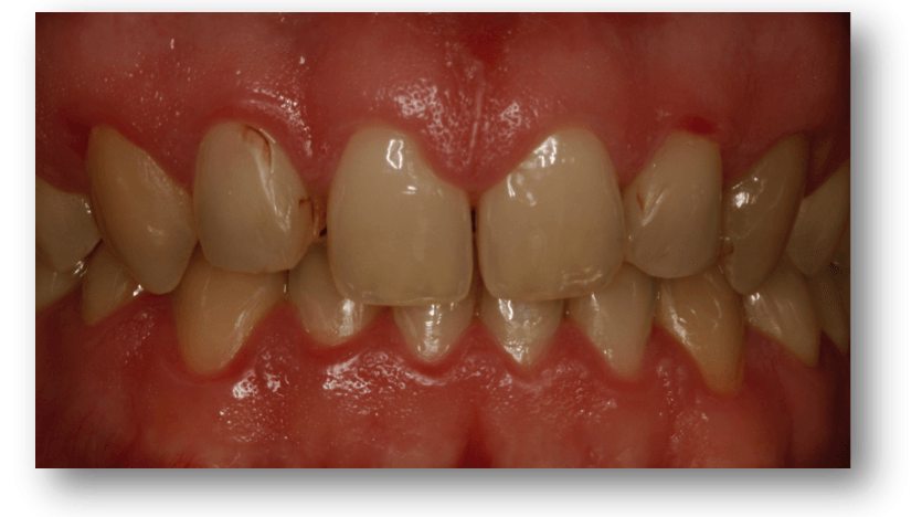 caso carillas dentales2