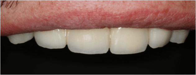 reconstruccion y rehabilitacion dental madrid2