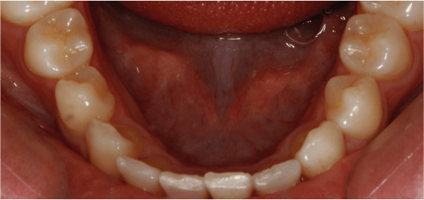 ortodoncia-alineadent-madrid-despues1