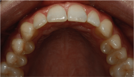ortodoncia-alineadent-madrid-despues2
