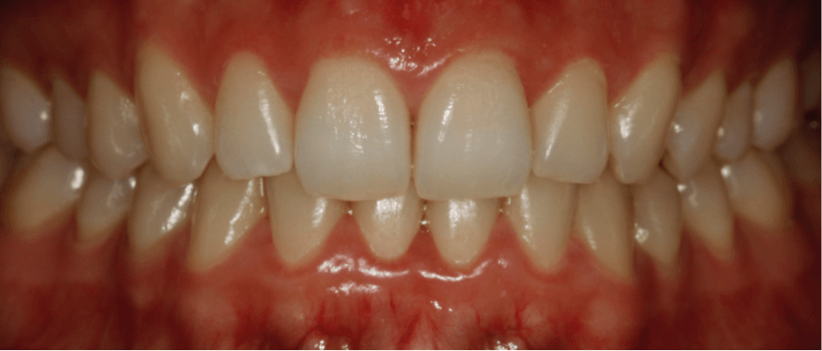 ortodoncia-alineadent-madrid-despues3