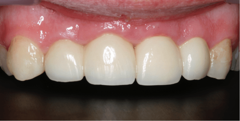 resultado final reconstruccion rehabilitacion dental