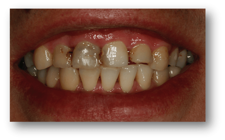 fotos reconstruccion rehabilitacion dental1