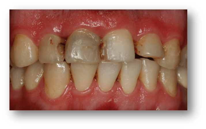 fotos reconstruccion rehabilitacion dental2