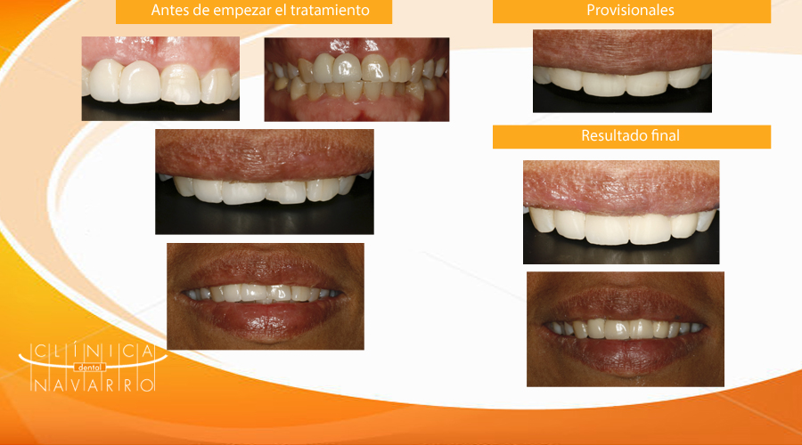 mejora de la estética del sector anterior dental en Madrid