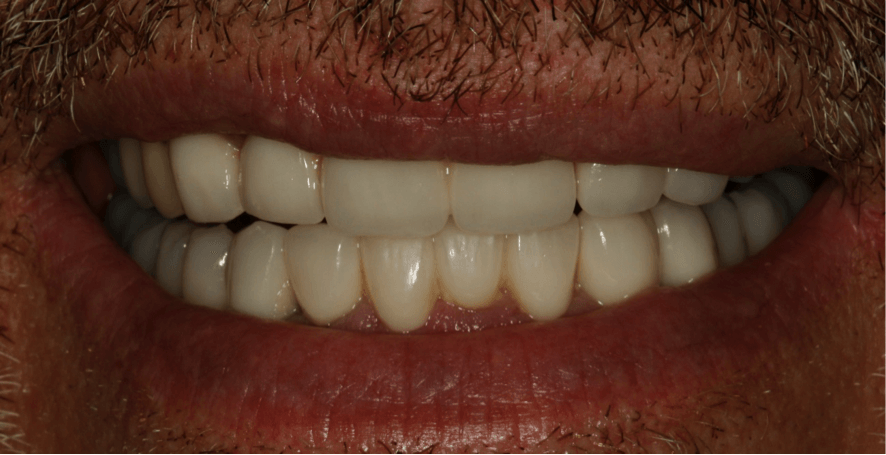 caso clinico rehabilitación dental con periodoncia e implantes dentales