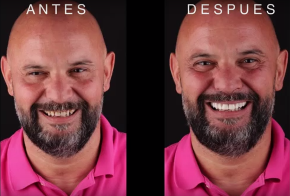 antes y después de DSD en caso clínico de Joserra en Dental Navarro Madrid