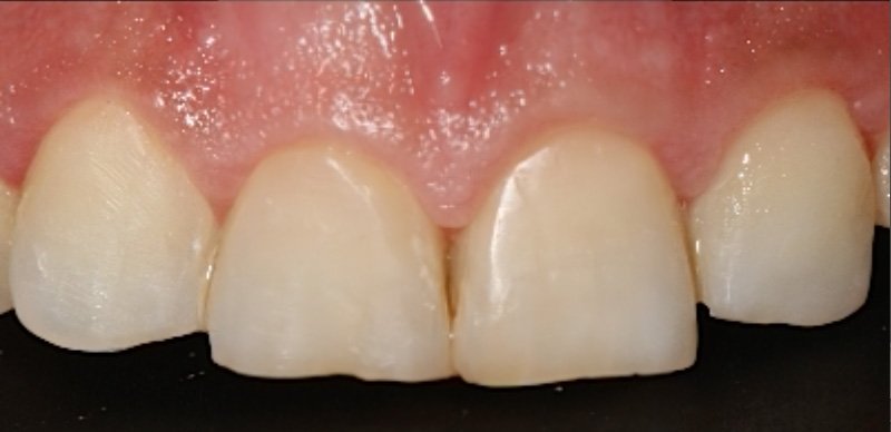 Solución a sensibilidad dental y caries con composite estético y estratificación