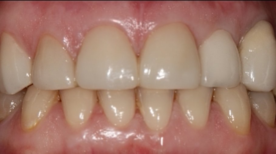 resultado tratamiento con carillas dentales de disilicato de litio