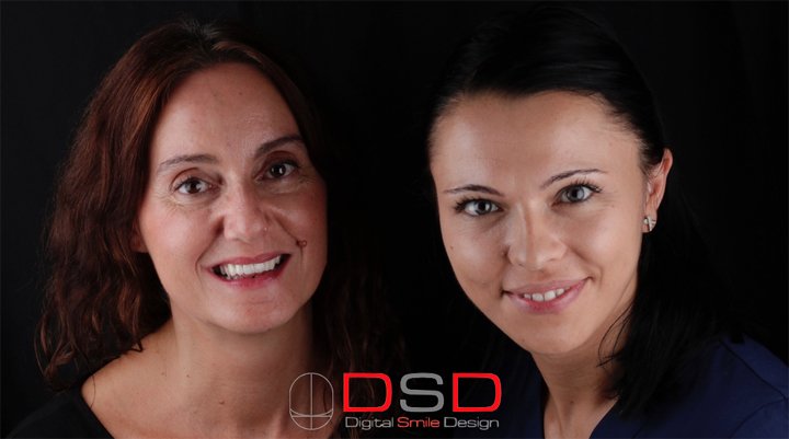 caso de diseño de sonrisa digital de Alicia en Clínica Dental Navarro Madrid