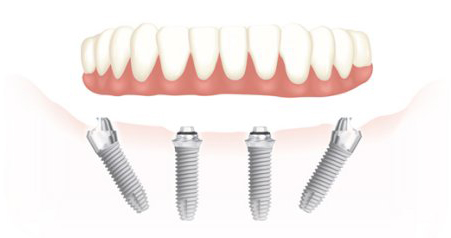 Tratamiento de implantes dentales All on 4 en Madrid