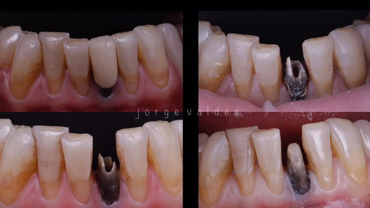 proceso de la rehabilitación de corona en diente endodonciado