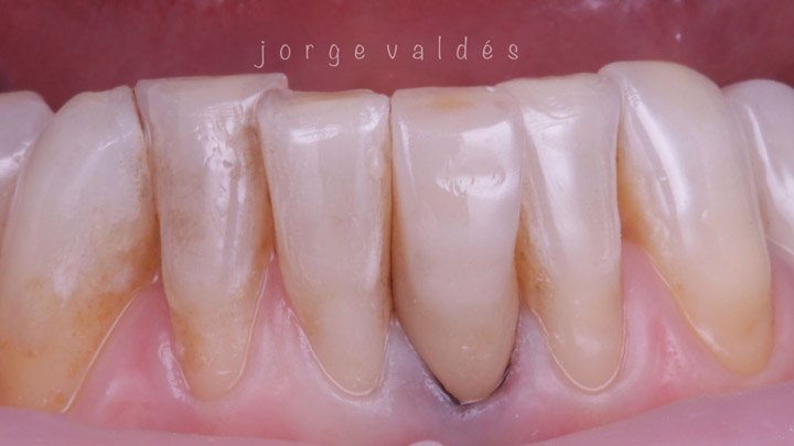 rehabilitación estética de corona en diente endodonciado