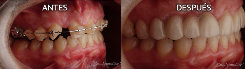fotos caso DSD ortodoncia y coronas disilicato