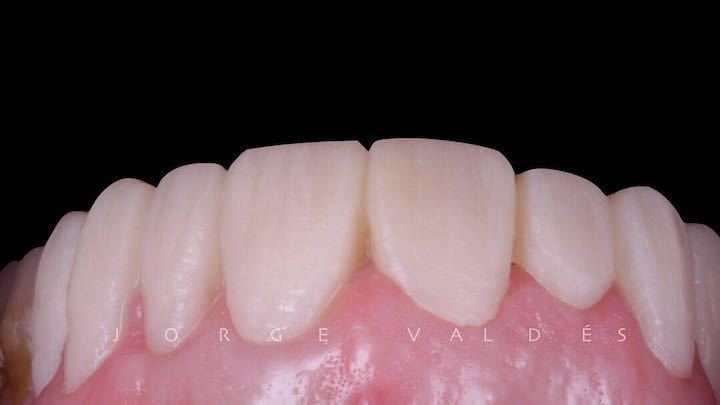 prueba en boca del caso clinico de carillas dentales