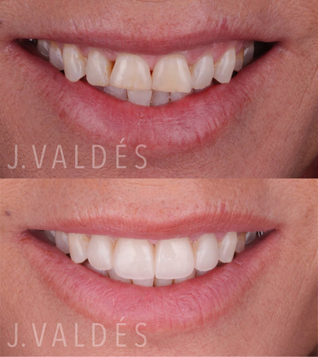ejemplos de carillas dentales en Madrid