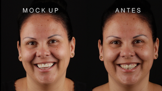 Fotos de antes y después de tratamiento de Diseño de Sonrisa