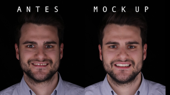 Caso práctico de uso de Diseño de Sonrisa con fotos de antes y después del paciente
