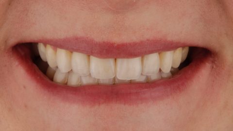 caso clínico de solución a dientes conoides mediante dsd, ortodoncia y carillas dentales prepless