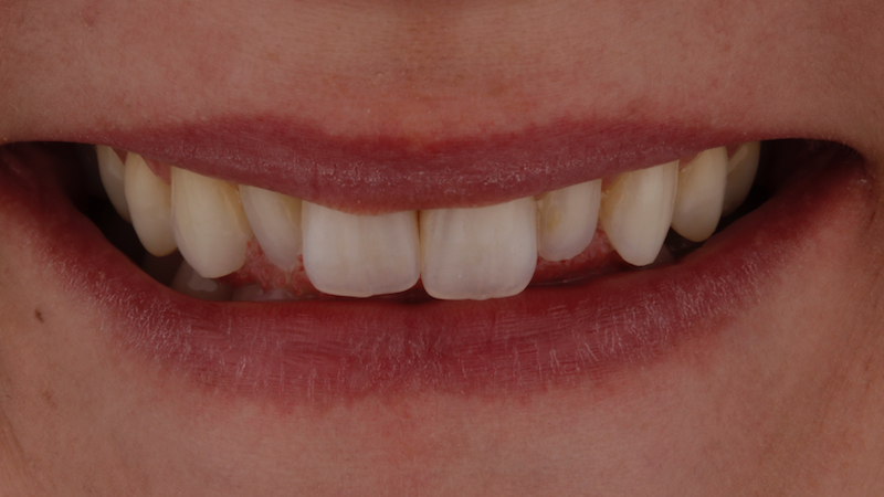 foto inicial con dientes conoides