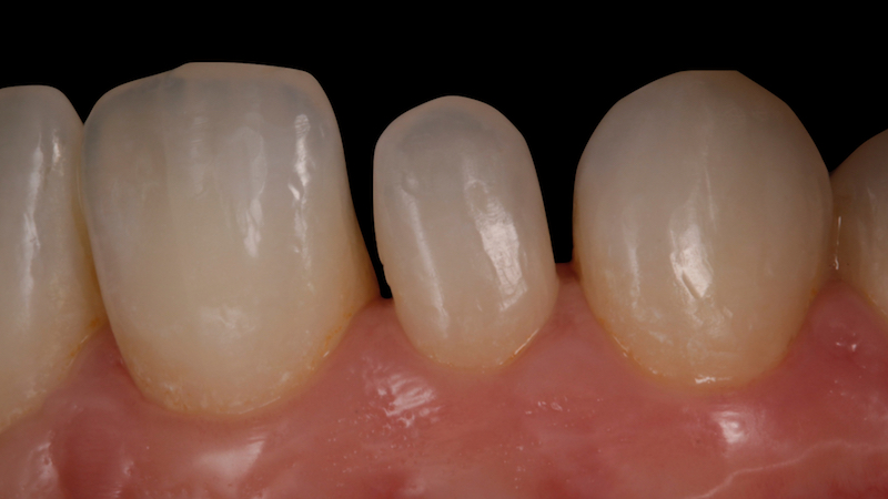 ortodoncia previa a colocación de carillas dentales