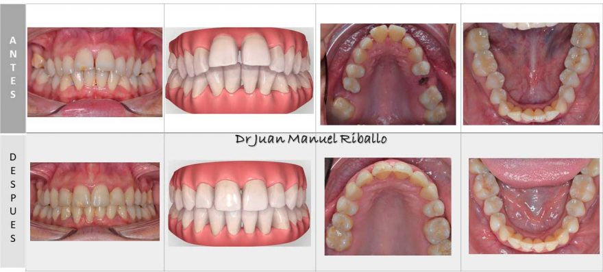 Ejemplos Y Casos De Pacientes De Ortodoncia Invisible Invisalign