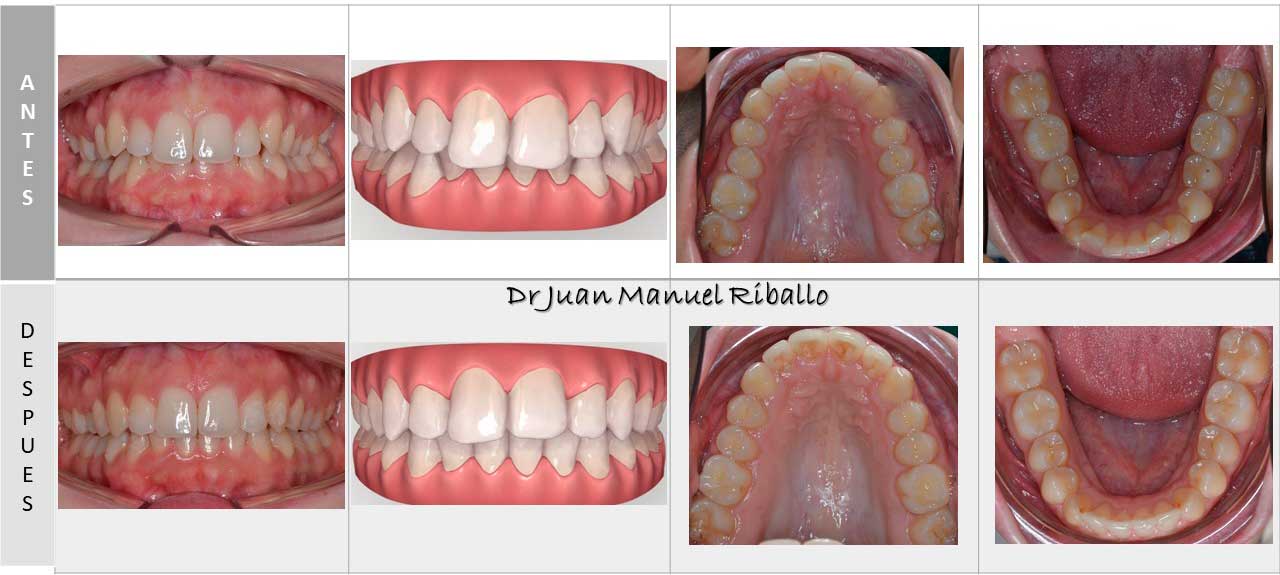 caso de ortodoncia Invisalign con vista previa por ordenador 2