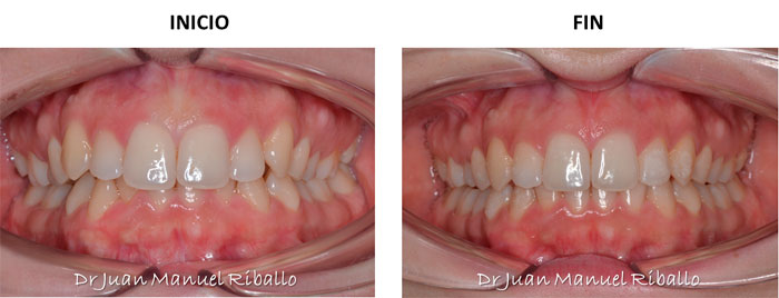 ejemplo 1 de ortodoncia invisalign 18 meses en Madrid