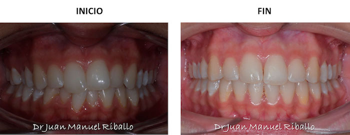 ejemplo 4 de tratamiento de ortodoncia invisalign en paciente de clínica dental Navarro