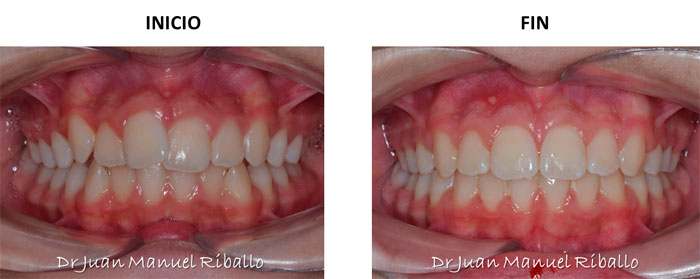 foto de ejemplo de caso en ortodoncia invisalign