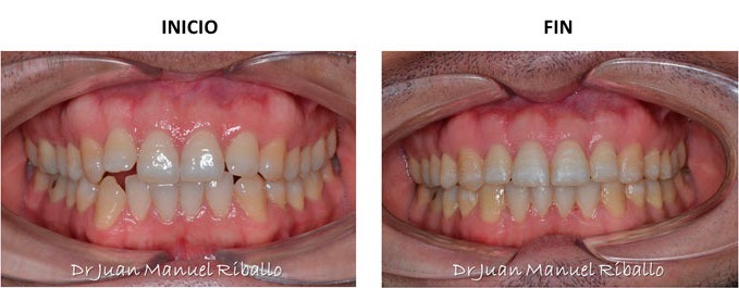 ejemplo de ortodoncia invisalign paciente 20 meses