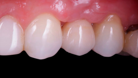 Caso clínico referente a la colocación de implante dental y corona después de extracción y preservación alveolar
