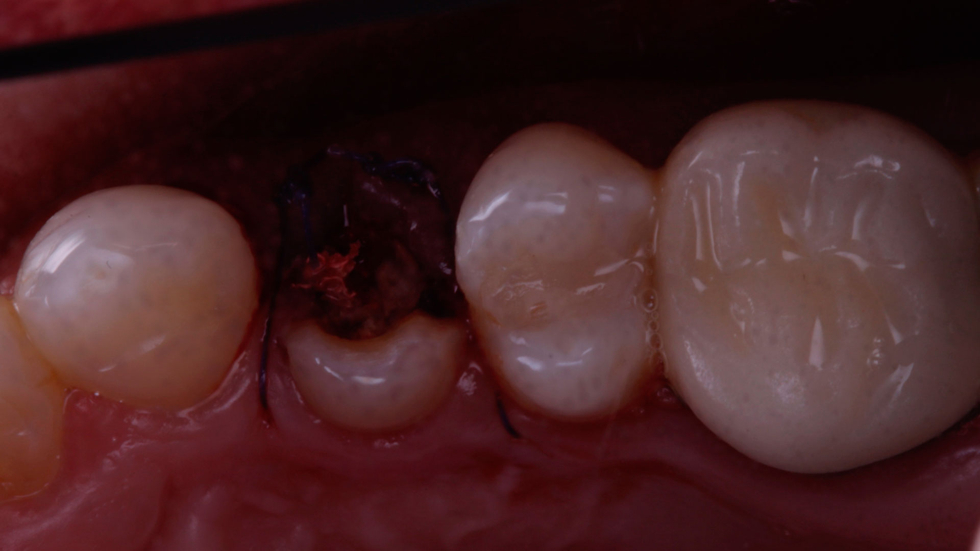 preservación alveolar para preparar encía para implantes dentales
