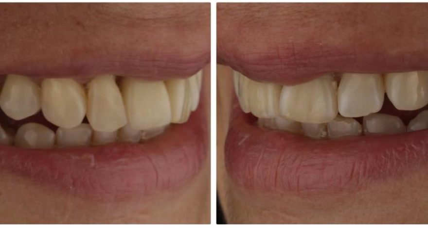 caso restauración de diente fracturado con infección mediante implantes dentales