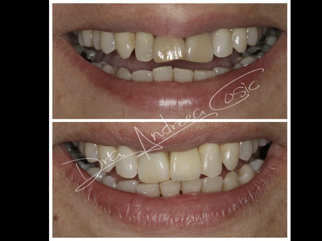antes y después sustitución de diente fracturado por implante dental
