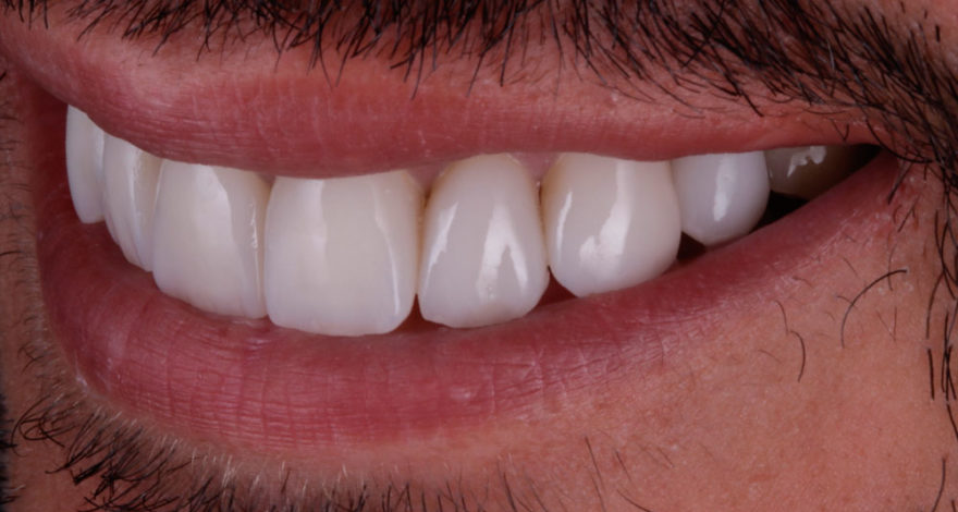caso-paciente-triangulos-negros-dientes-1