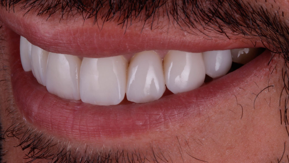 caso-paciente-triangulos-negros-dientes-1