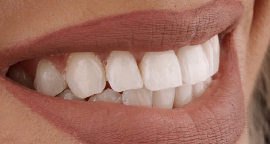blanqueamiento dental después de cambio de color en diente con traumatismo