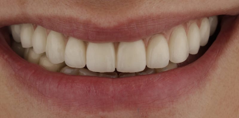 caso clínico de rehabilitación superior completa con implantes dentales