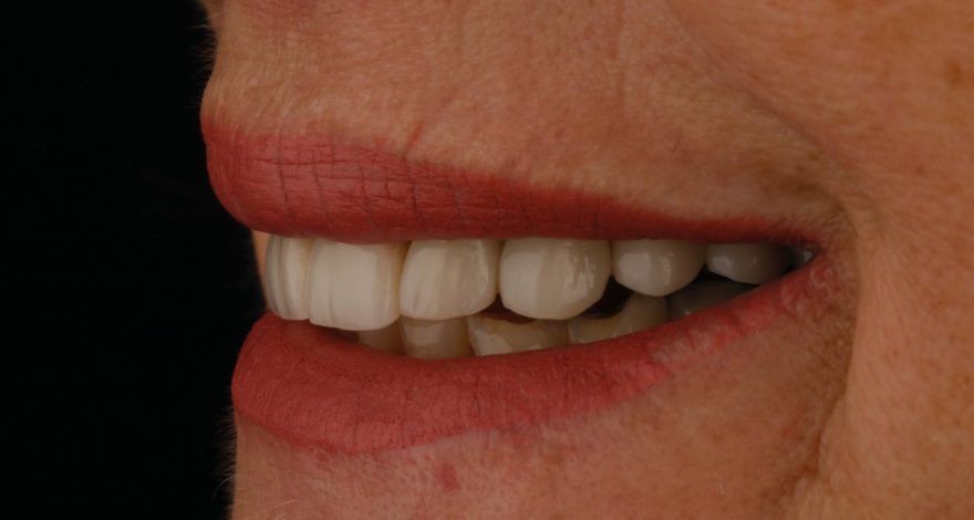Paciente con desgastes y fracturas en dientes