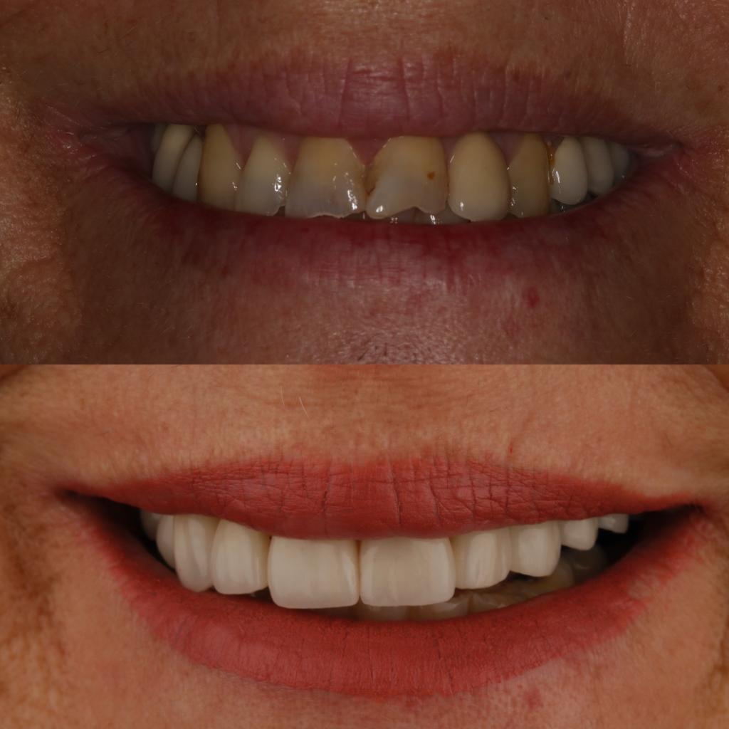 antes y después rehabilitación desgastes y fracturas dentales