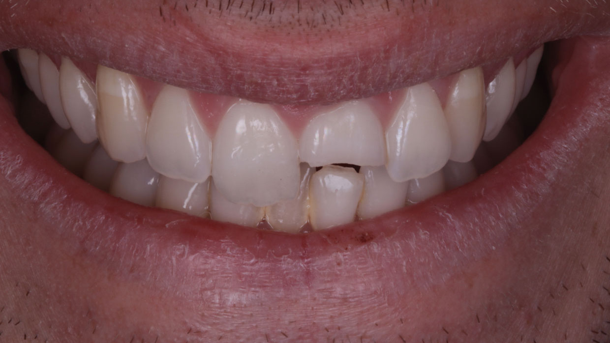 sonrisa diente roto traumatismo dental