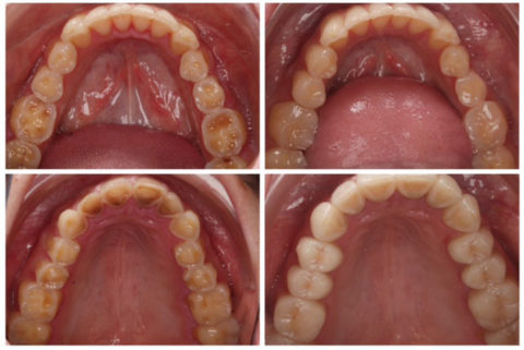 solución a desgastes dentales por reflujo y atrición