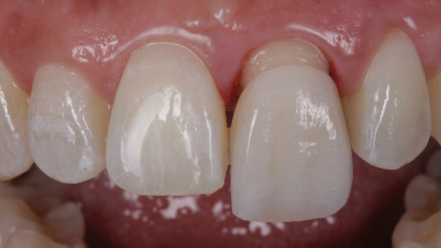 sustitución de corona dental de metal por una de disilicato de litio