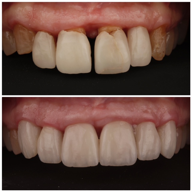 Carillas dentales y famosos. Antes y después. - Uniclinic